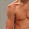 Операция на плечевом суставе привычный вывих в спб thumbnail