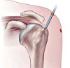 Артроскопический шов повреждения ротаторов плеча