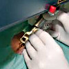 Лазерное лечение буллезной болящей дистрофии роговицы
