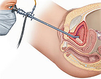 Процедура Цистоскопия у женщин