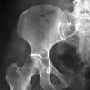 Рентген подвздошной кости