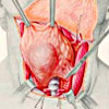 Удаление щитовидной железы