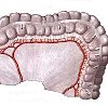 Ангиопластика брыжеечной артерии