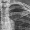 Рентген грудино-ключичного сочленения