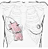 Реконструкция груди собственными тканями