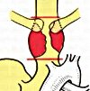 Циркулярная резекция грудного отдела трахеи