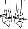 Остеосинтез заднего края большеберцовой кости