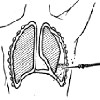 Плевральная пункция