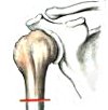 Резекция головки плечевой кости