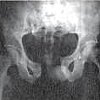 Рентген крестцово-подвздошного сочленения